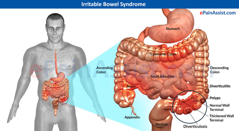 Add Qualifying Condition Irritable Bowel Syndrome IBS Arkansas 